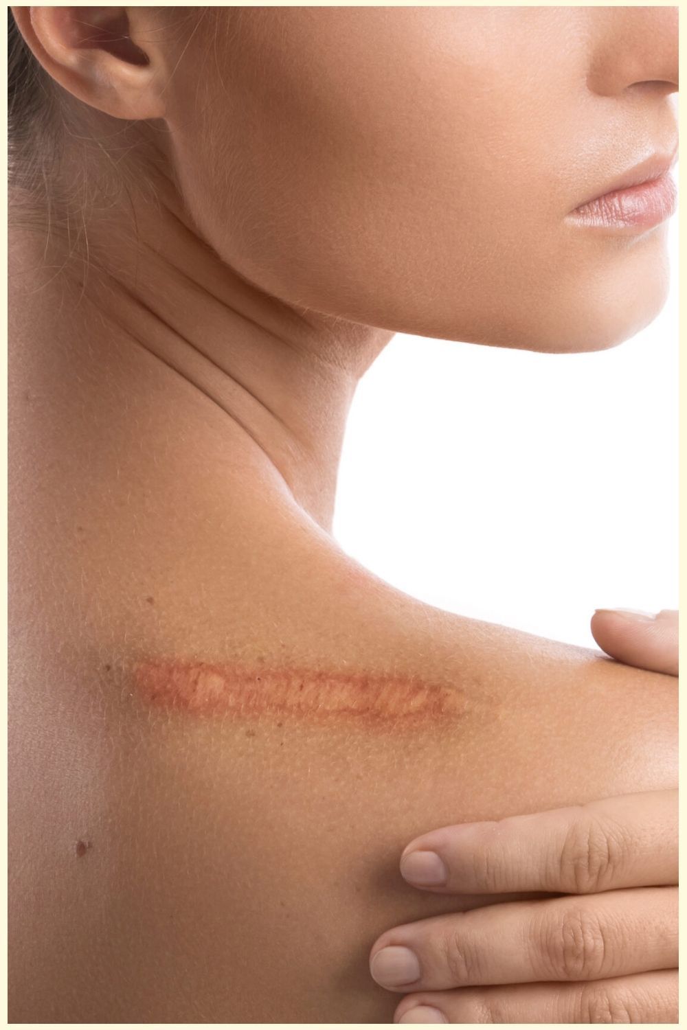 Surgical scar treatment