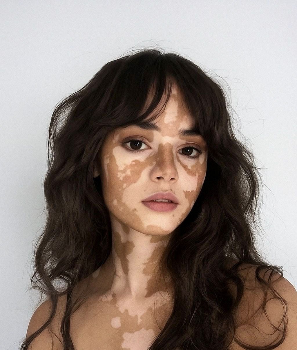 Advanced Treatment for Vitiligo
