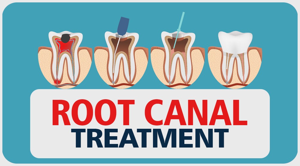 Root Canal