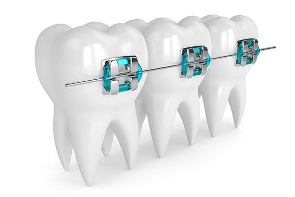 Orthodontics treatment