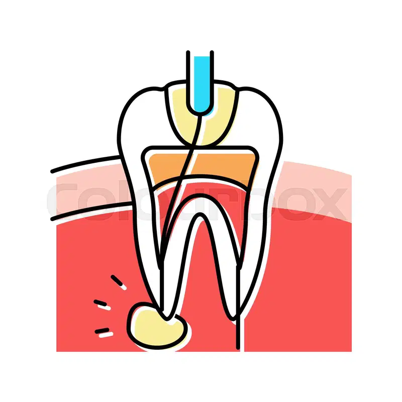 ROOT CANAL TRETMENT