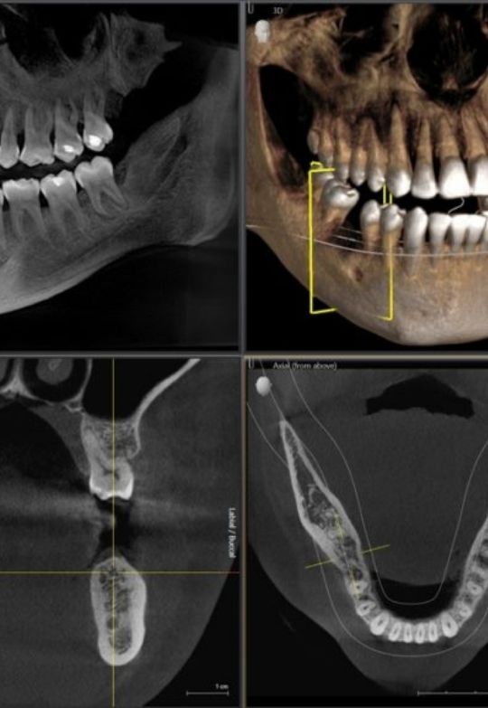 CBCT