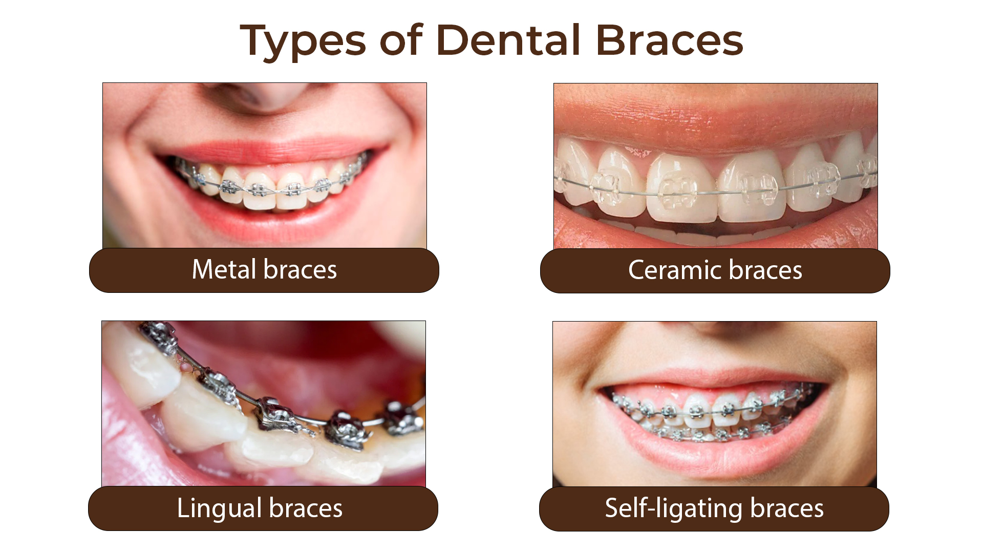 Orthodontic Treatment
