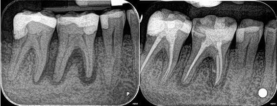 ROOT CANAL TREATMENT