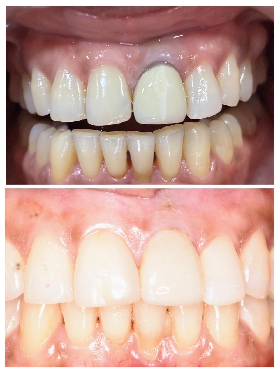 Zirconium Crowns