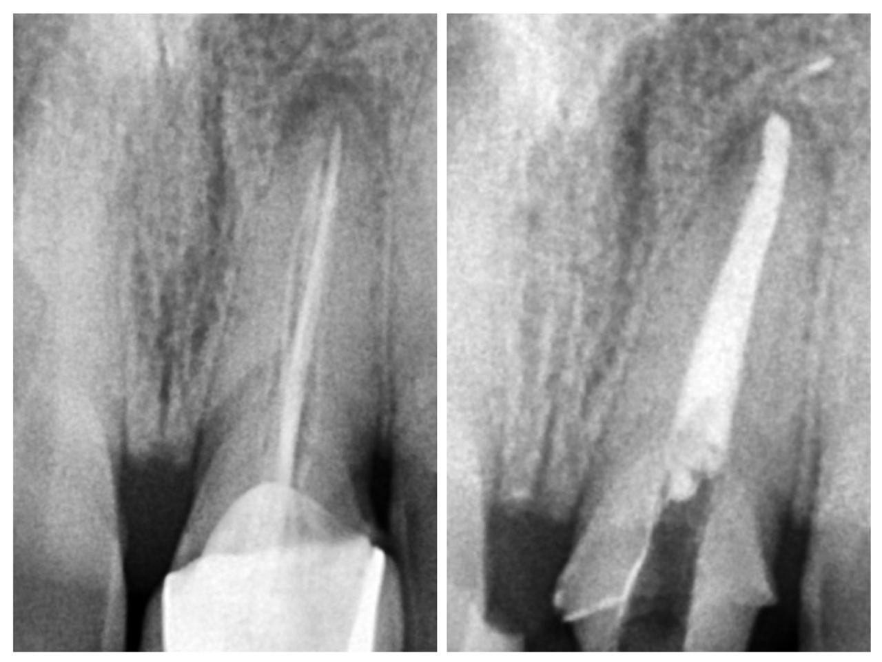 Re-Root Canal treatment