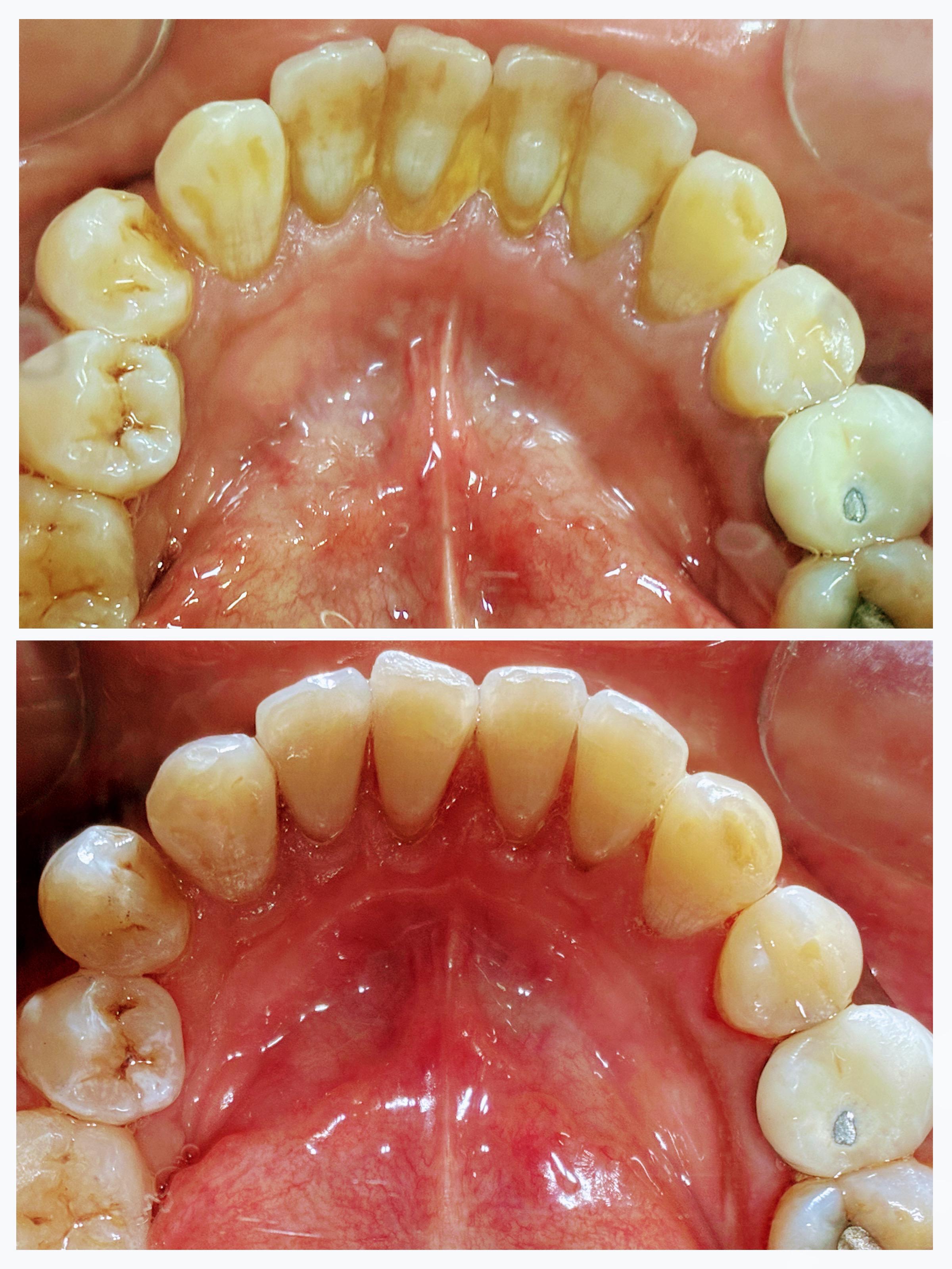 Dental Scaling