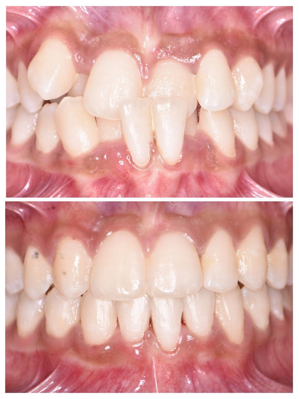 Braces