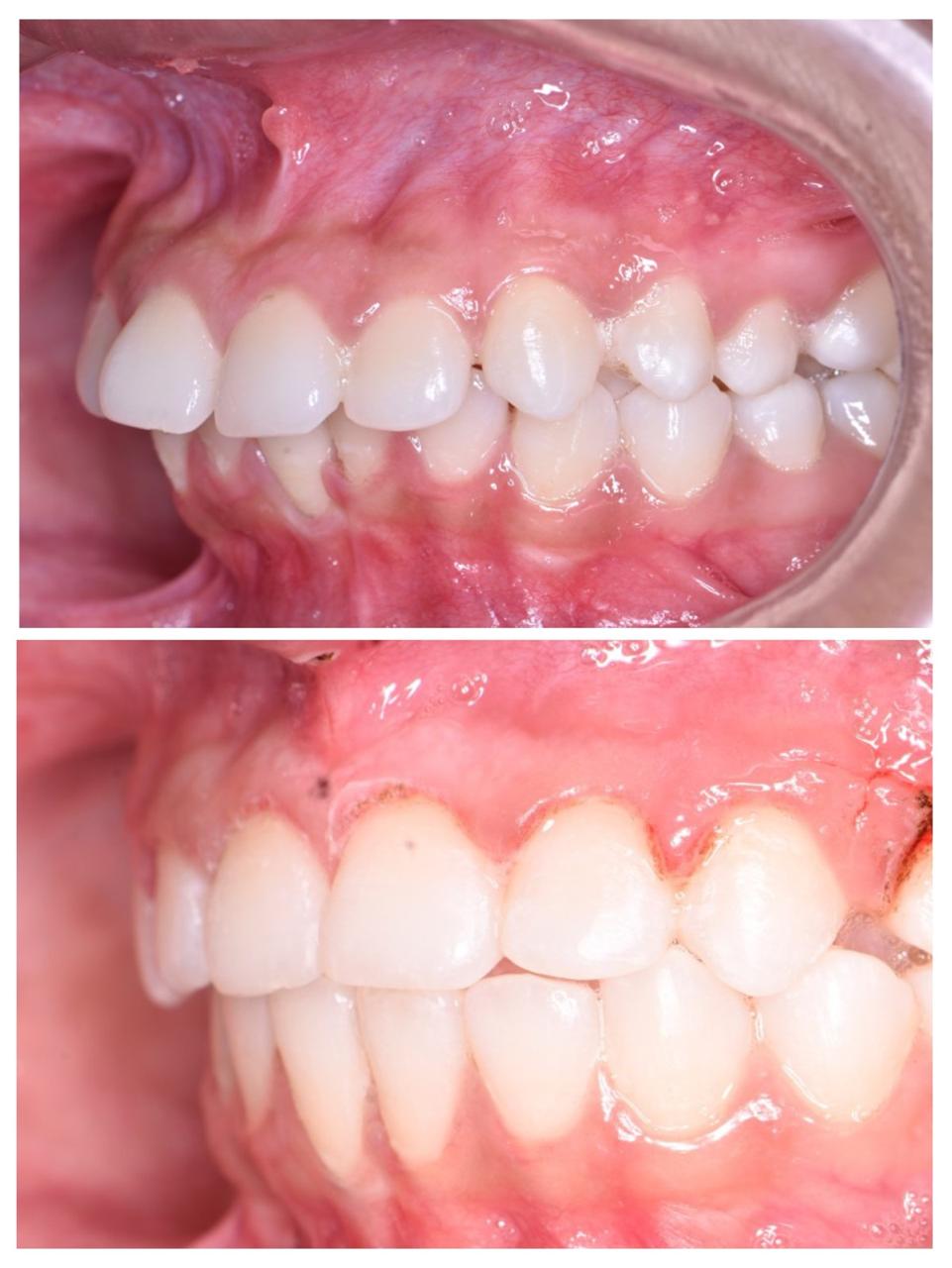 Forwardly placed Front teeth