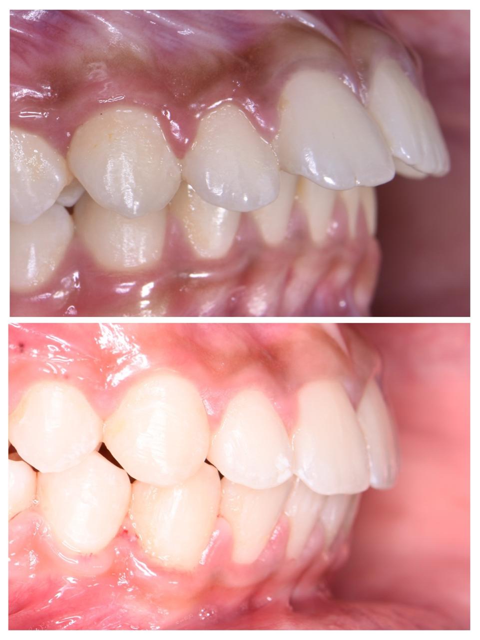 Forwardly placed Front teeth without Removal of teeth