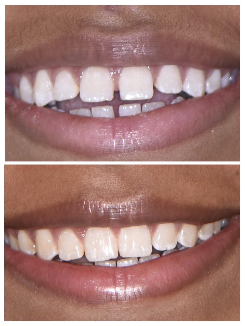 Clear Aligners