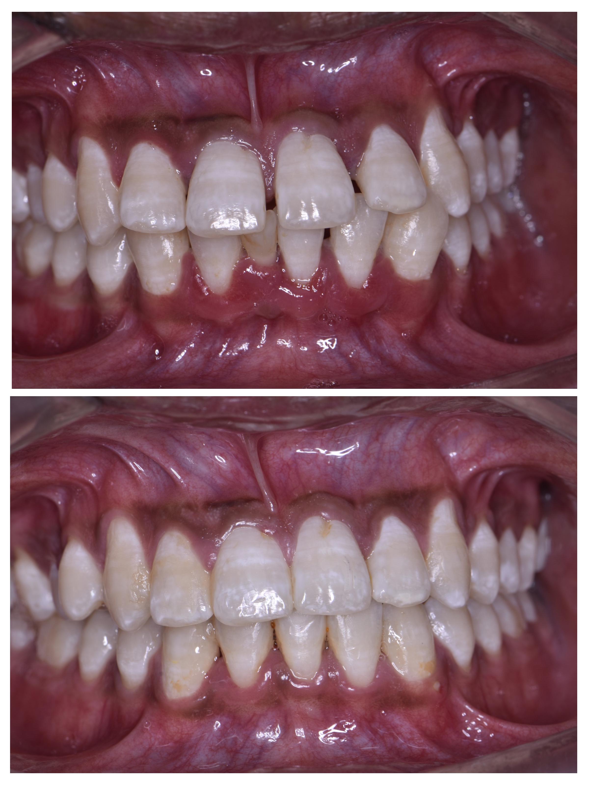 Close Gaps with Braces