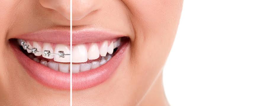Dental Braces