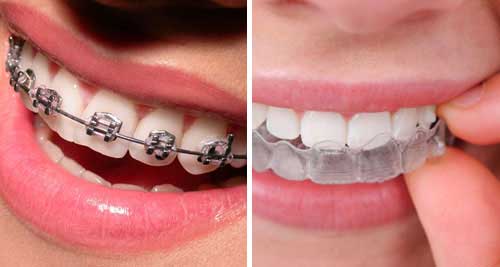 Early Orthodontic Intervention and Aligners