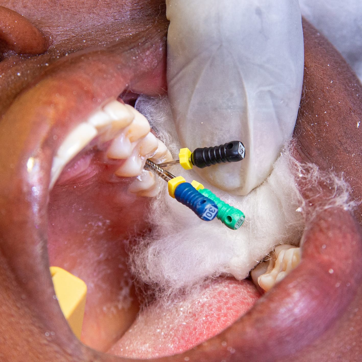Root canal treatment/Pulp therapy for kids/Endodontic treatments