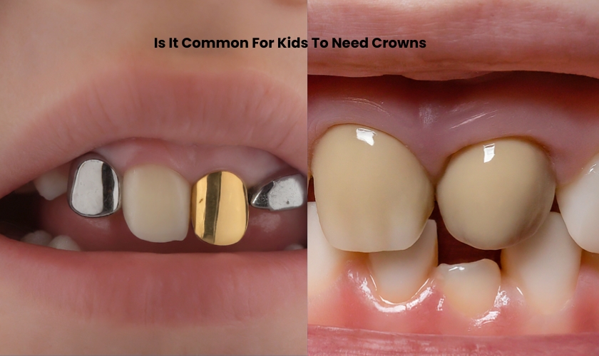 Stainless steel crowns / zirconia crowns/strip crowns /Crowns and bridges