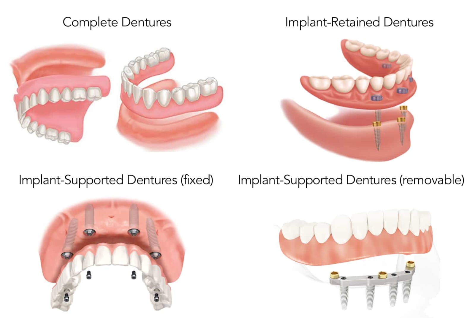 Dentures fixed/ removable partial/ conventional/ implant supported