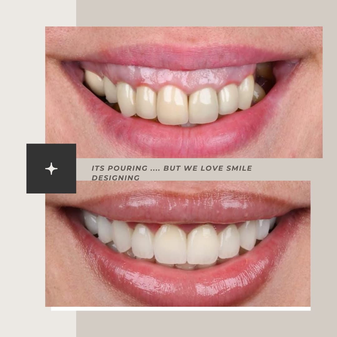 Smile designing with veneers / composites