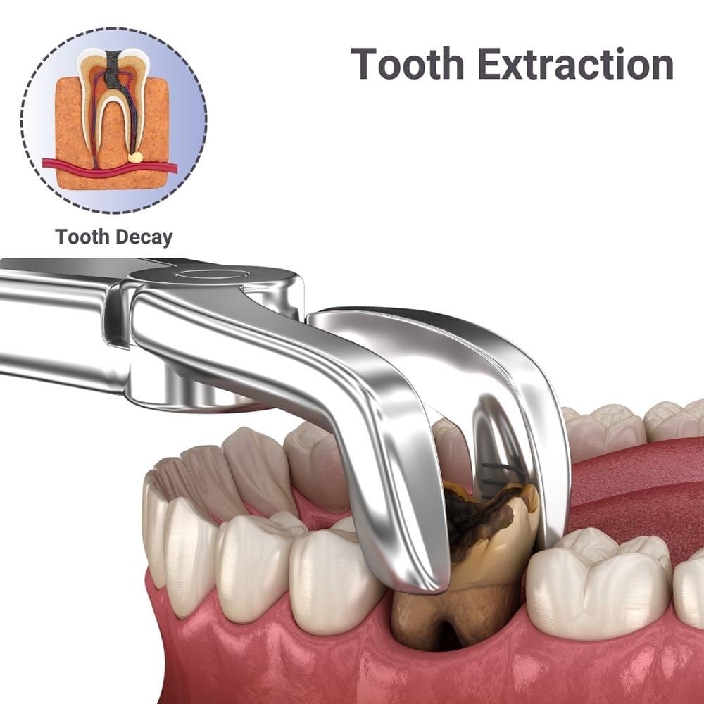Extractions for kids / adults/ wisdom tooth removal