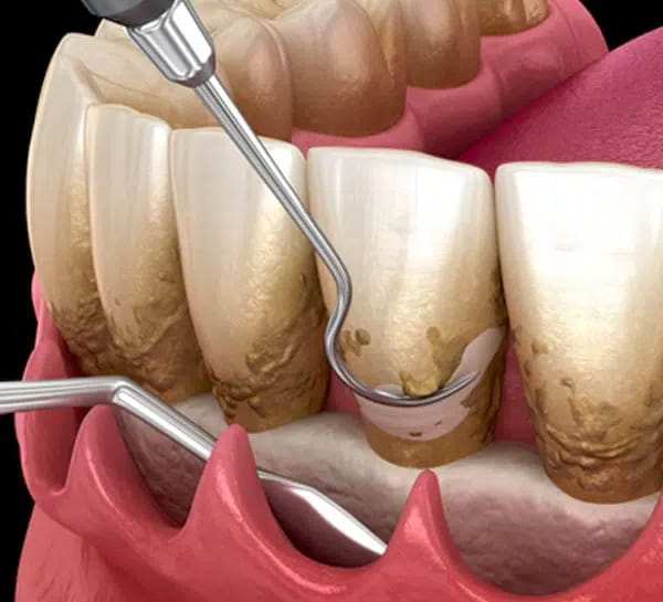 Gum surgeries / Crown lengthening procedures/ frenectomy/ tongue tie