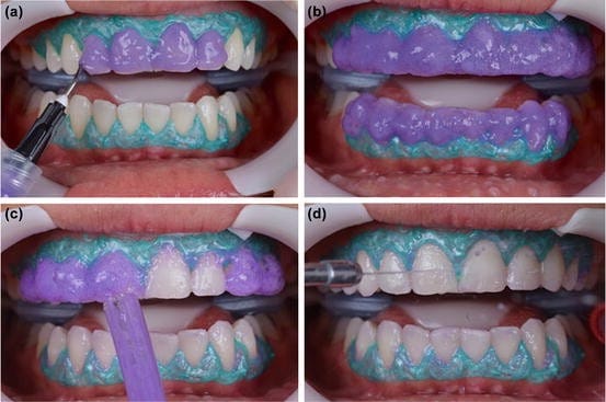 Teeth whitening/ bleaching