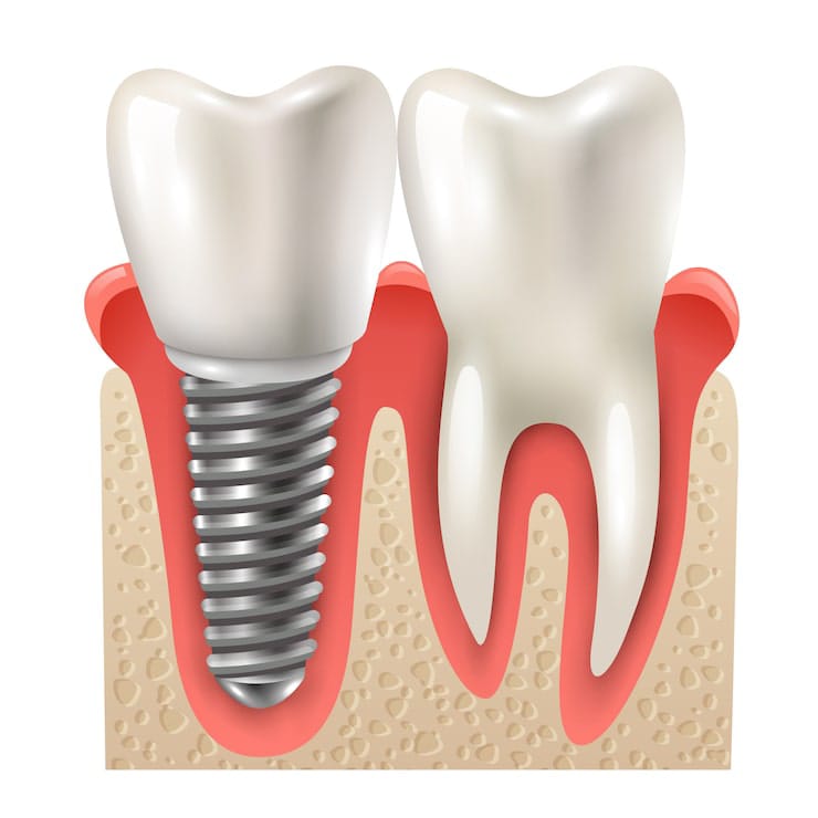 Implant dentistry