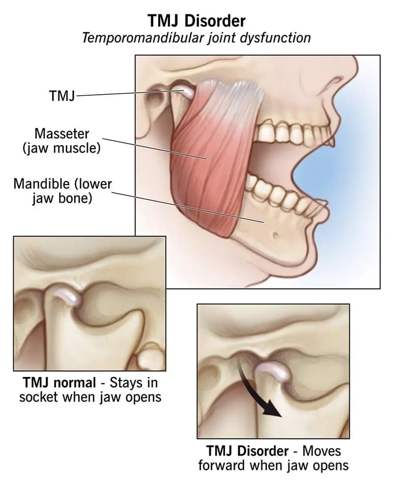 TMJ consultation and counselling with treatment