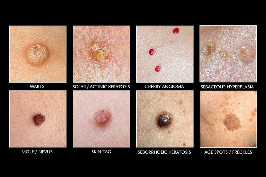 Electrocautery and Radio frequency ablation