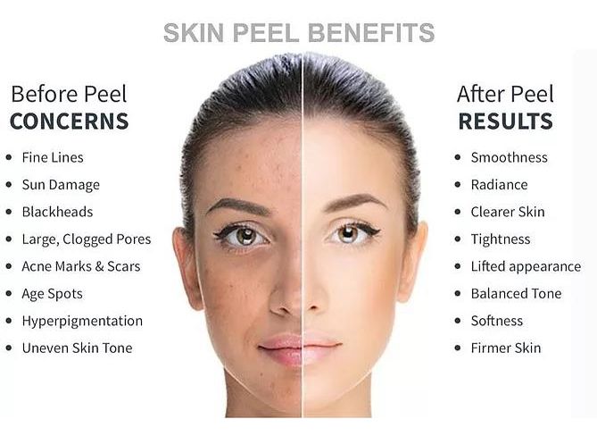 Chemical peels