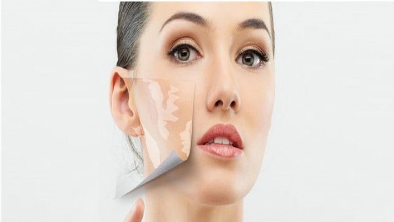 VITILIGO SURGERIES