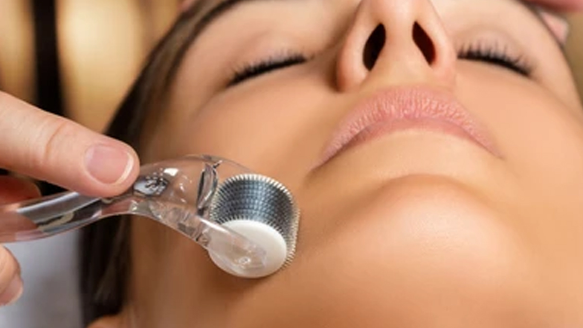 ACNE SCAR SURGERIES