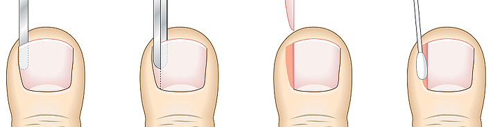 NAIL SURGERIES
