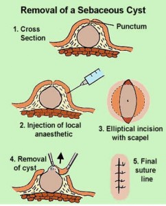 Excision of Benign & Selected Malignant Skin Conditions