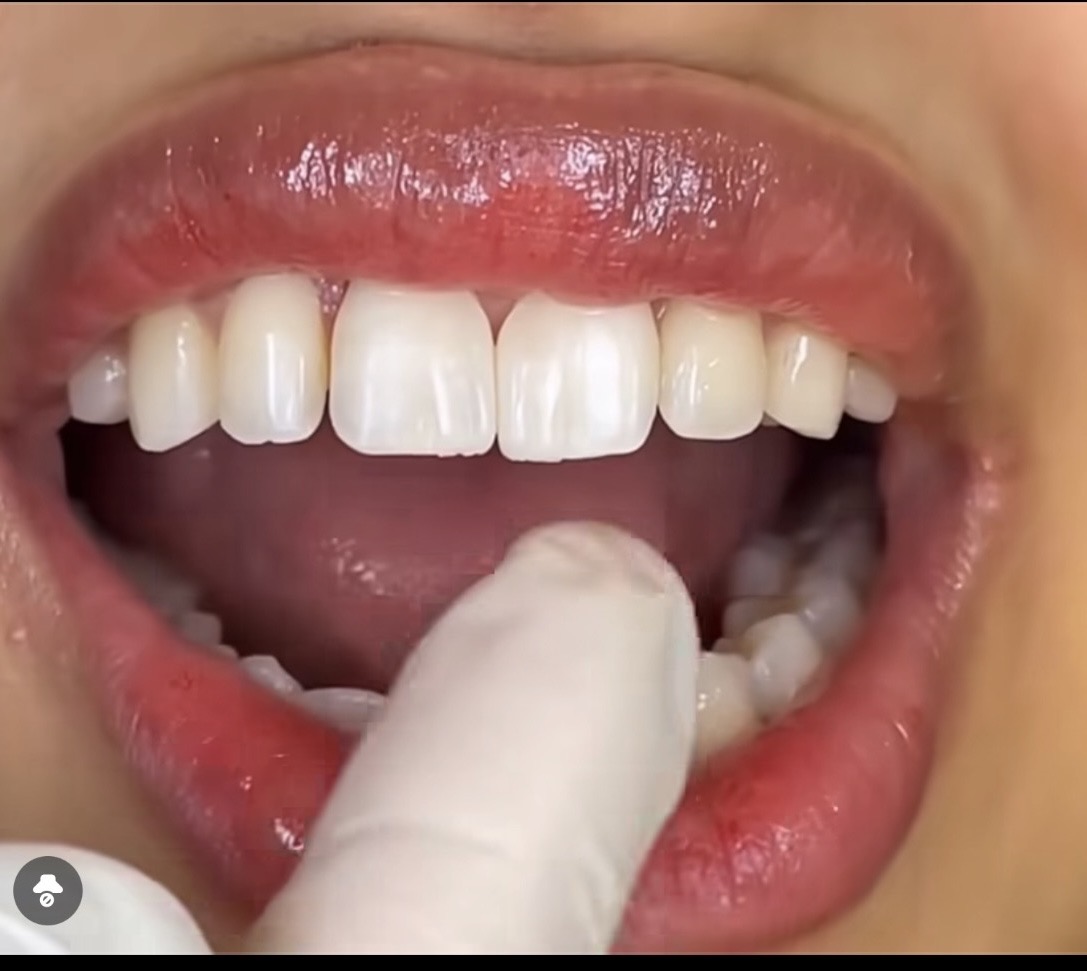 Tooth whitening