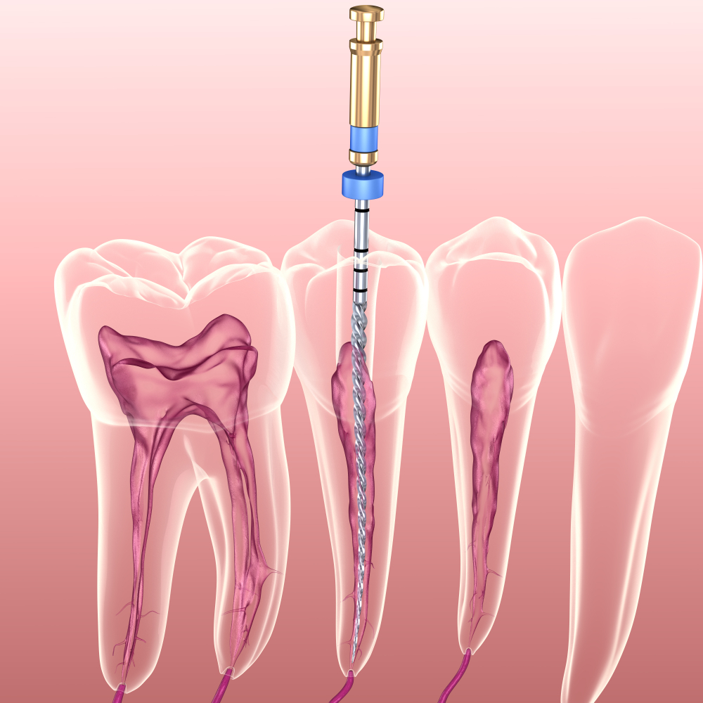 Root Canal Treatment