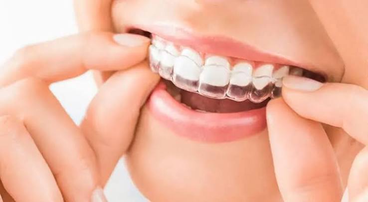 Invisible Aligner