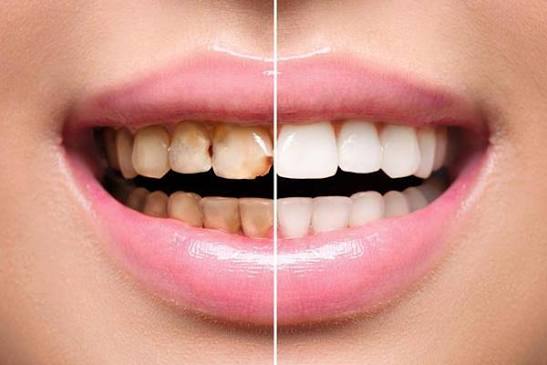 Dental Laminates