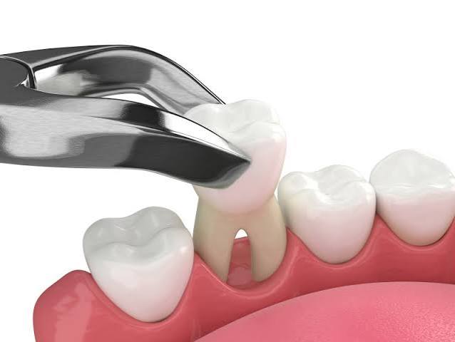 Painless Tooth Extraction