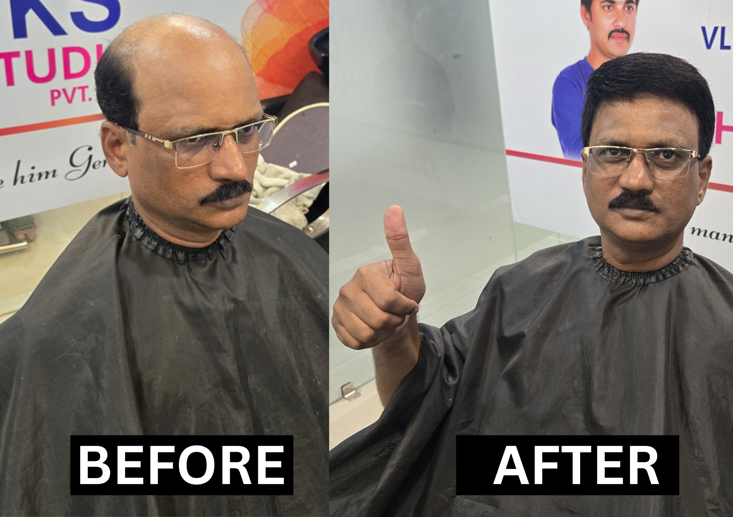 Non surgical hair replacement
