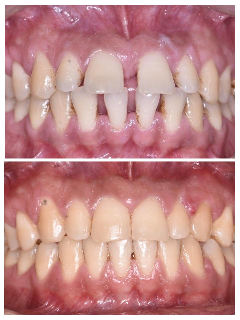 Space Closure-Braces