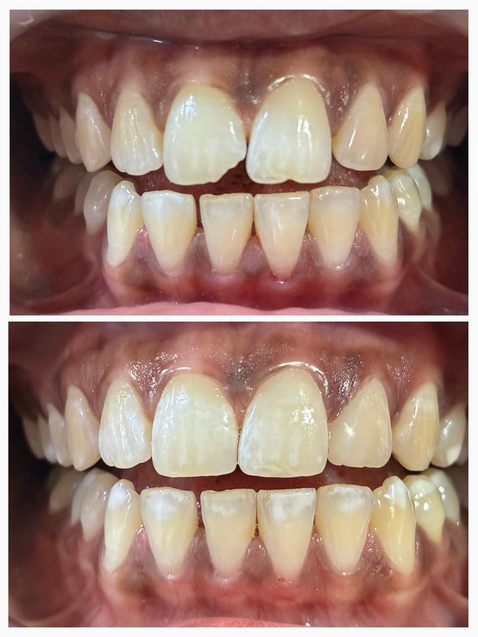 Broken Tooth- Tooth colored Filling