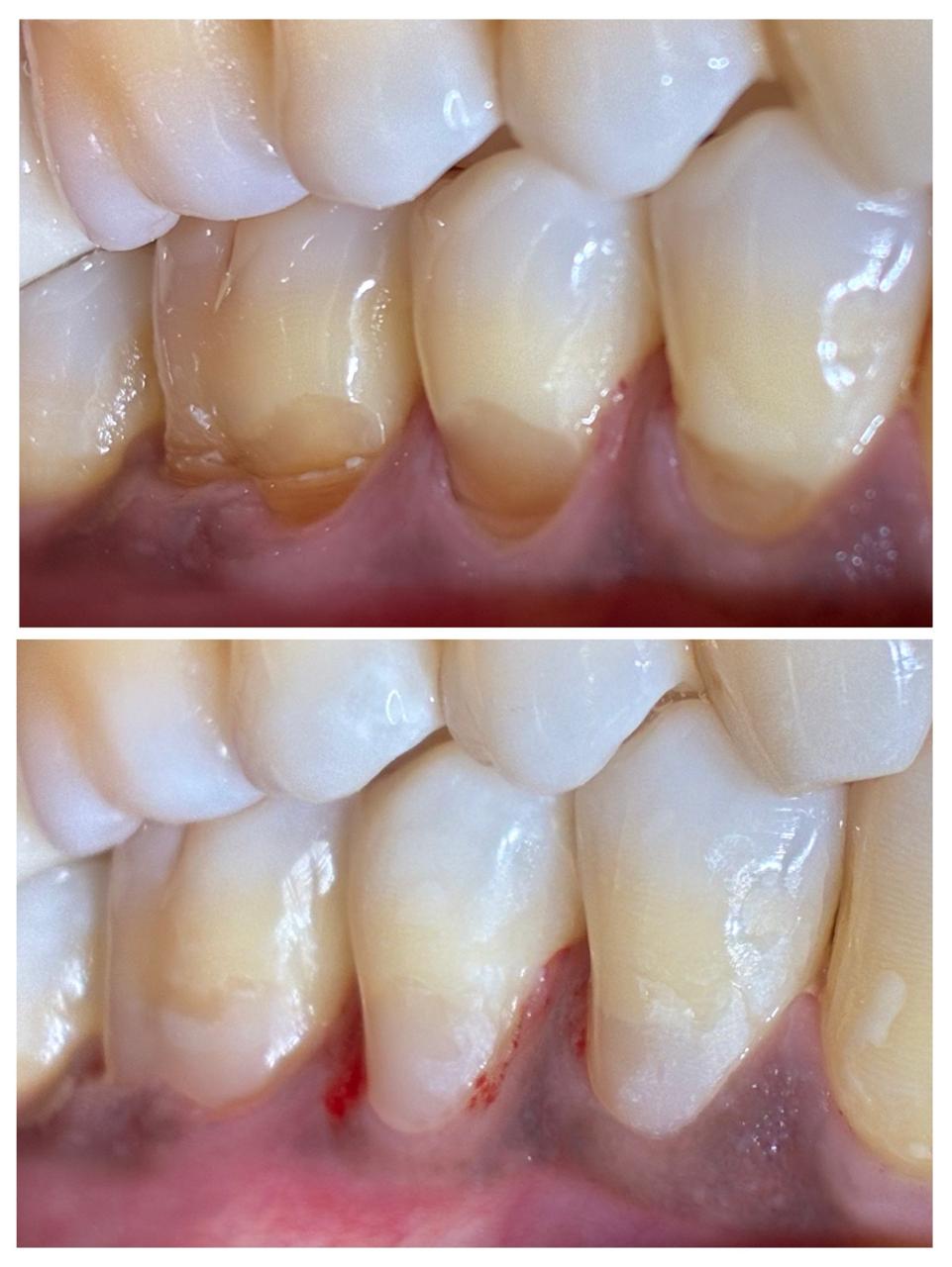 Worn out teeth-Tooth colored fillings
