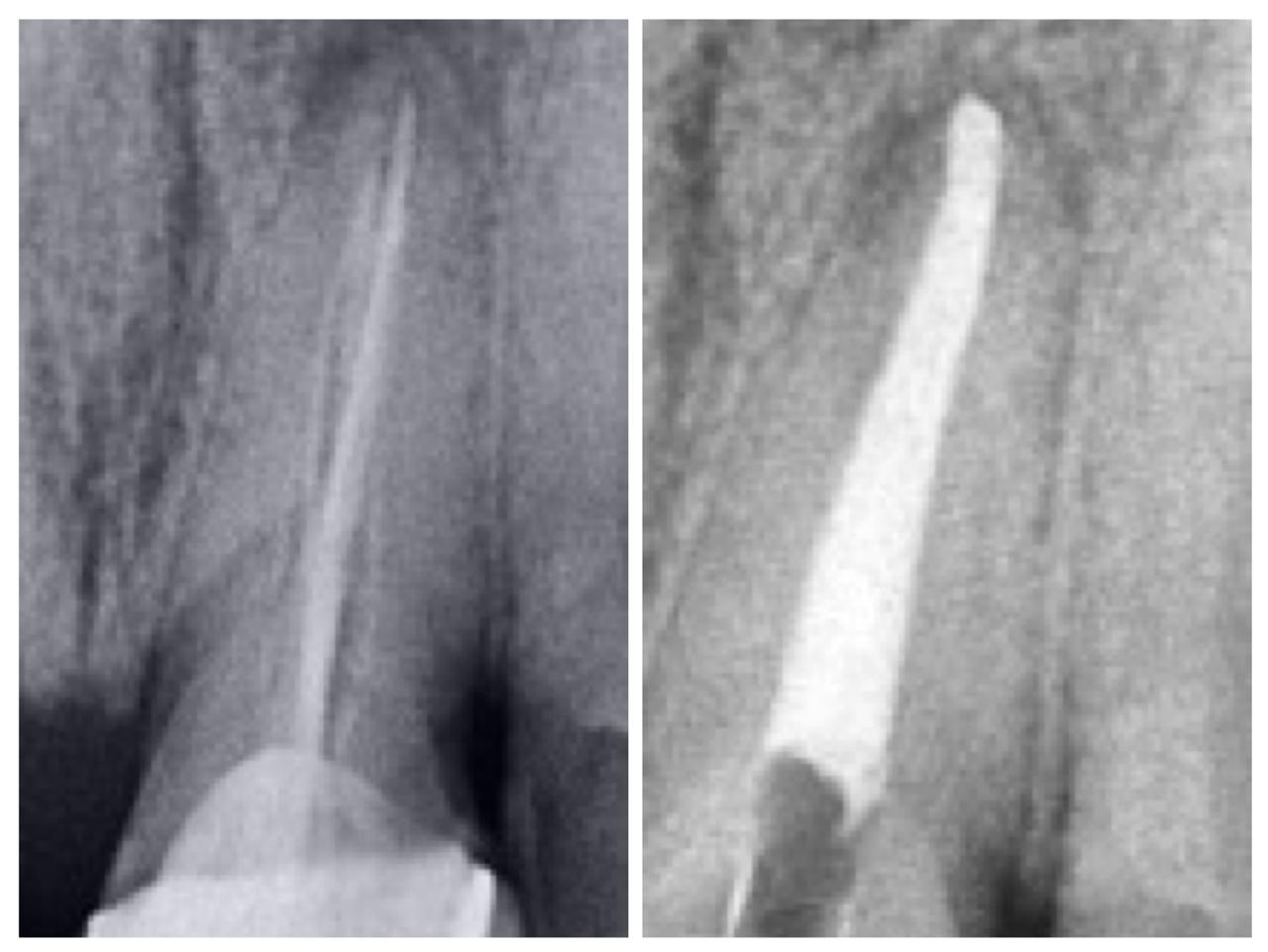 Improper previous Root canal-Retreatment