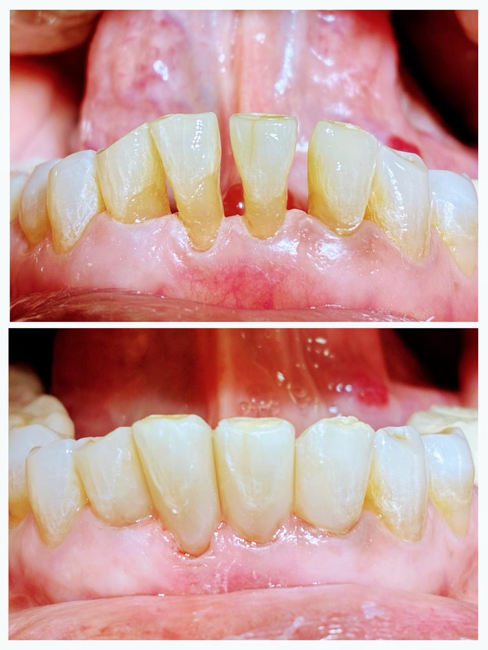 Gap closure-Natural shade matching Fillings