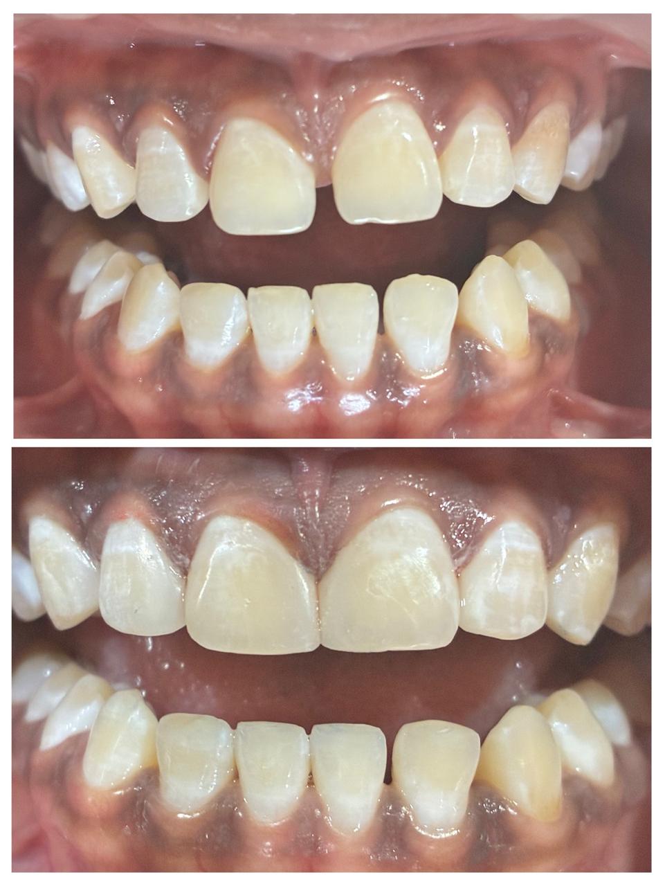 Instant Smile Makeover  - Single visit
