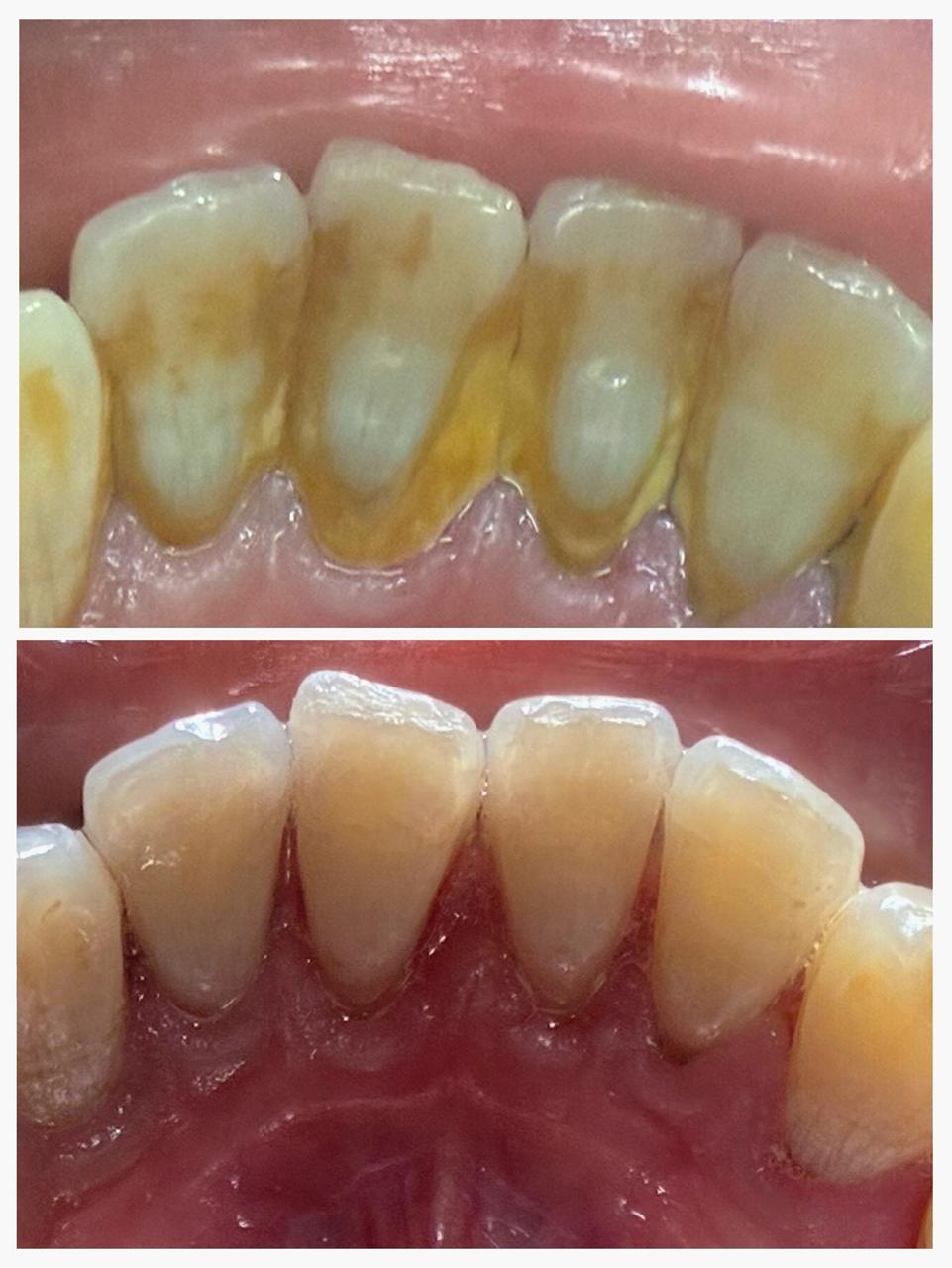 Sparkling Clean teeth-Professional Scaling