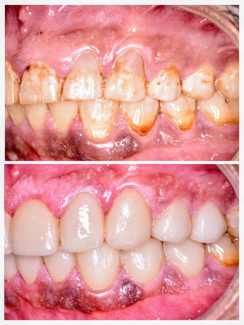 Veneers/Laminates