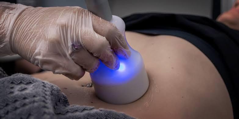 Cryosculpting and U-Lipolysis Body Contouring