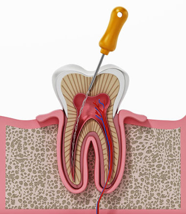 Root Canal